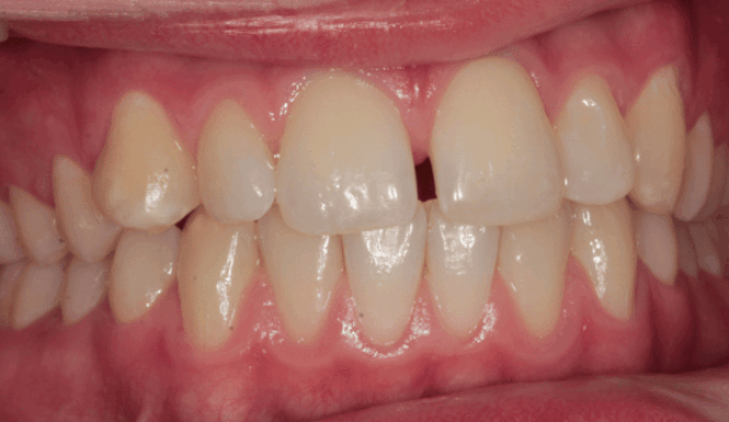 Before - DNTL Smiles