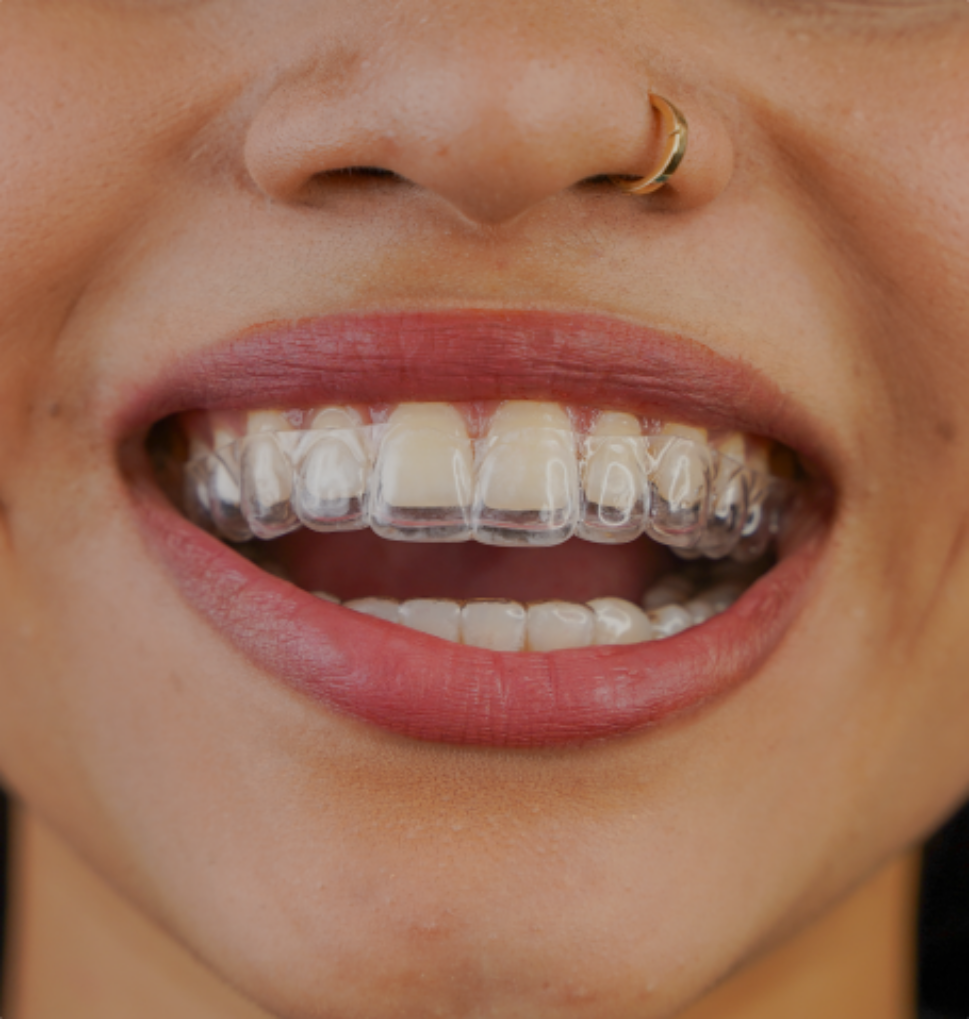  invisalign_image