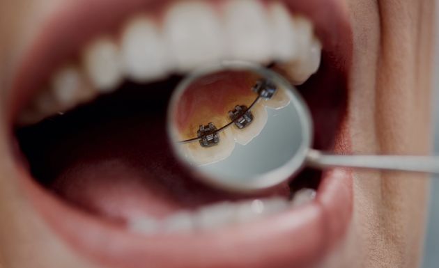 Treatment - DNTL Smiles & Wellness