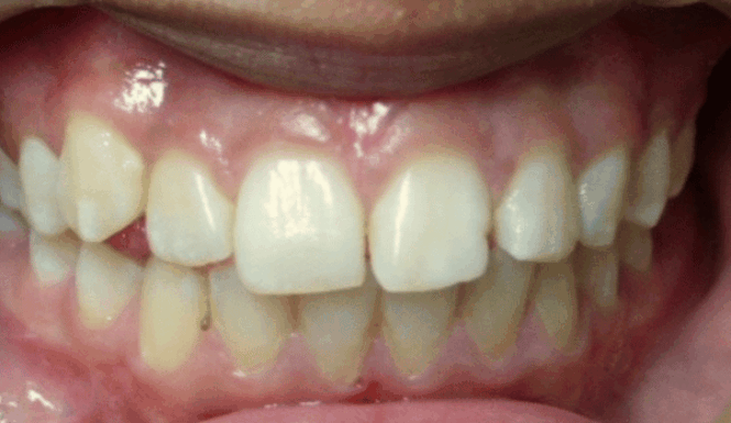 Before - DNTL Smiles