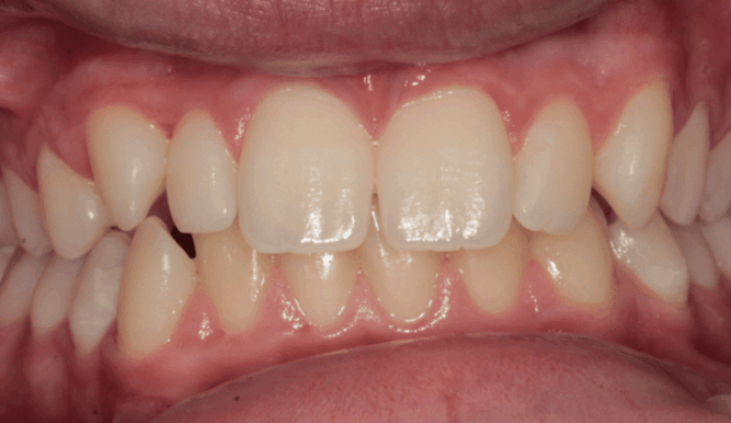 Before - DNTL Smiles