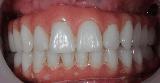 After - DNTL Smiles & Wellness