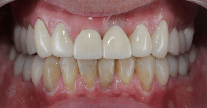 After - DNTL Smiles & Wellness