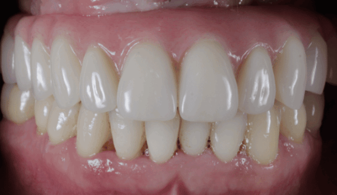 After - DNTL Smiles & Wellness