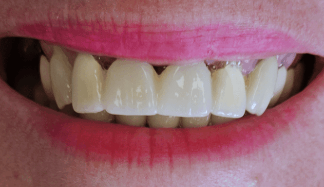 After - DNTL Smiles & Wellness