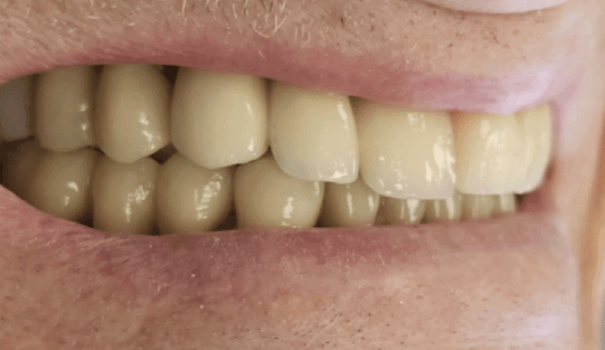 After - DNTL Smiles & Wellness