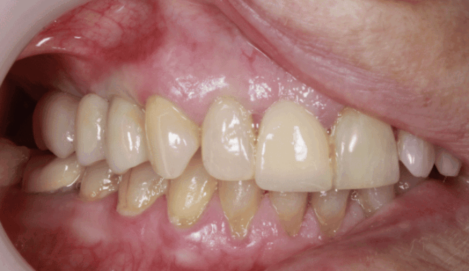 After - DNTL Smiles & Wellness